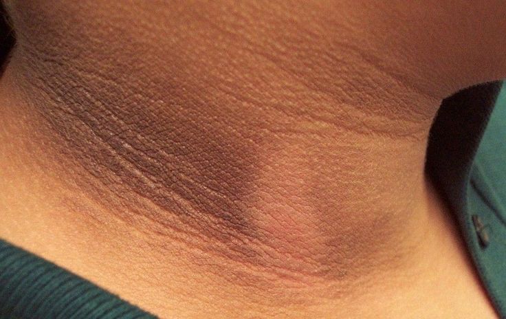 Unraveling the Mystery of Neck Hyperpigmentation and possible solutions