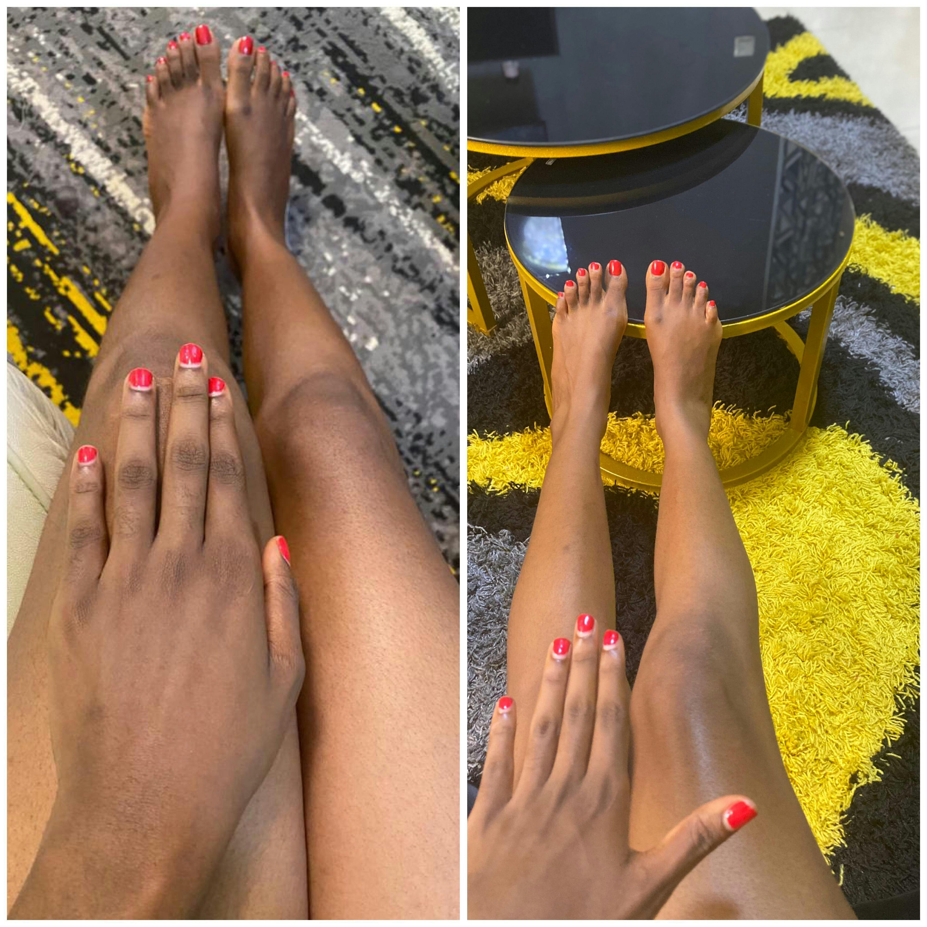 before and after image of a customer's leg after using myremih skincare product