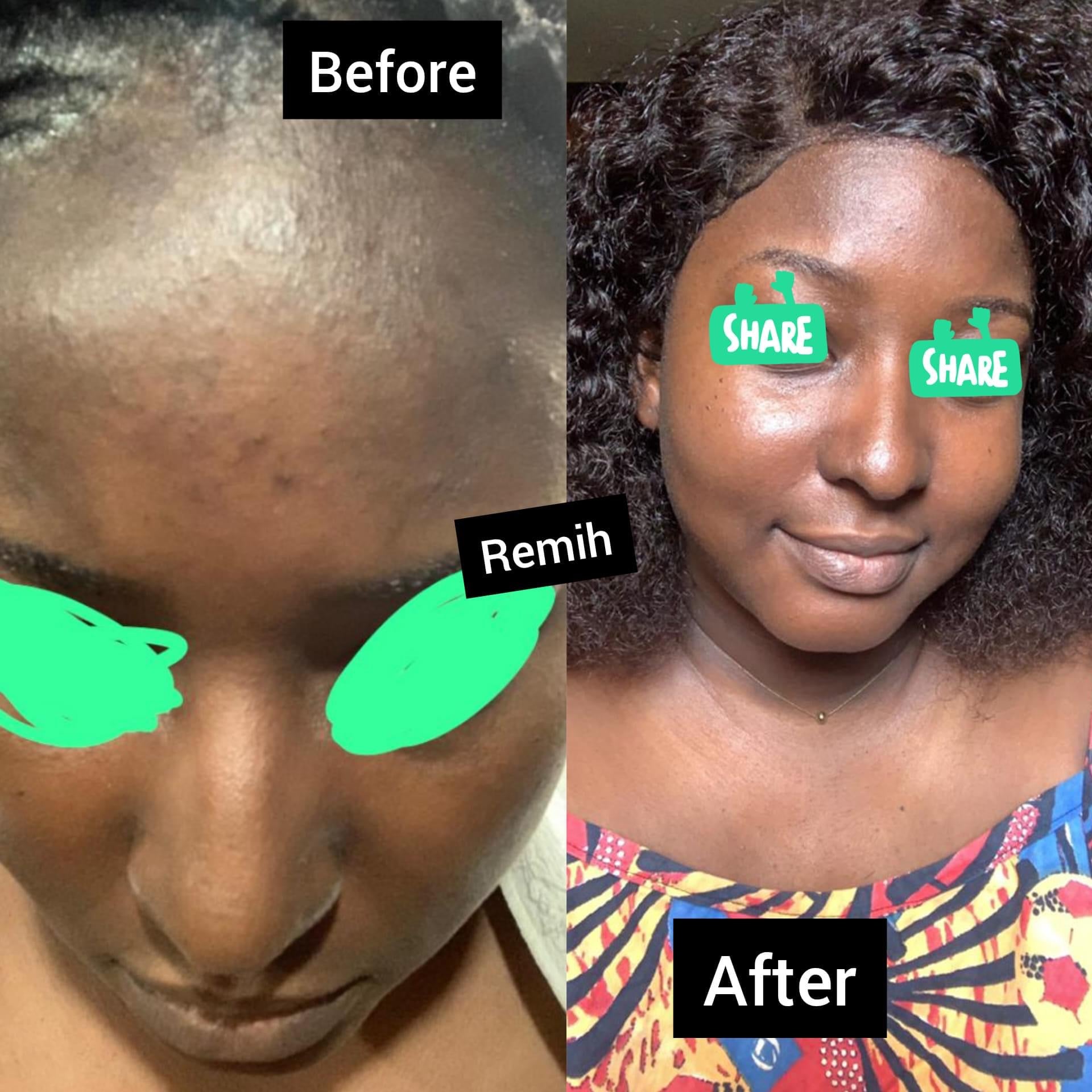 testimonial showing the before and after image of the usage of myremih skincare product.