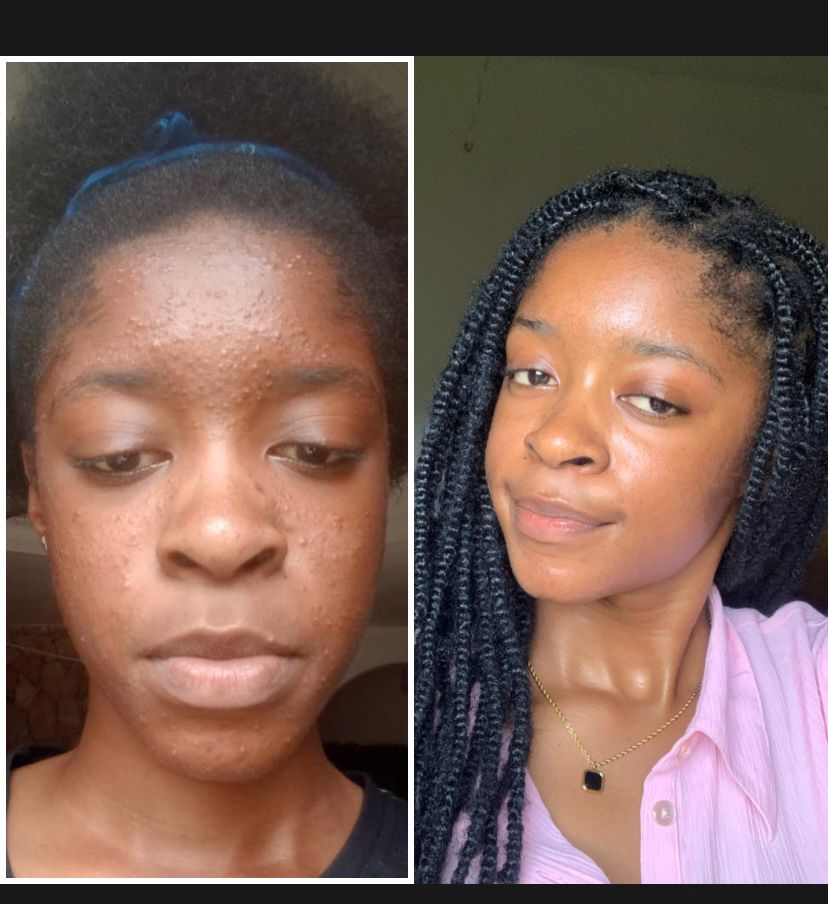 image showing the before and after usage of remih skincare product from a rough and broken skin to a smooth and moisturizing skin