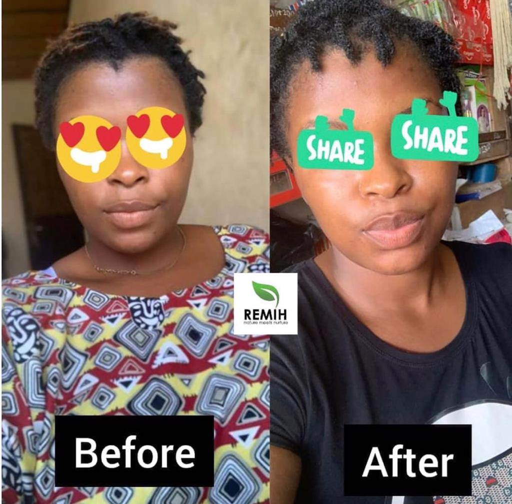 testimonial images showing the before and after effect of using myremih skincare products