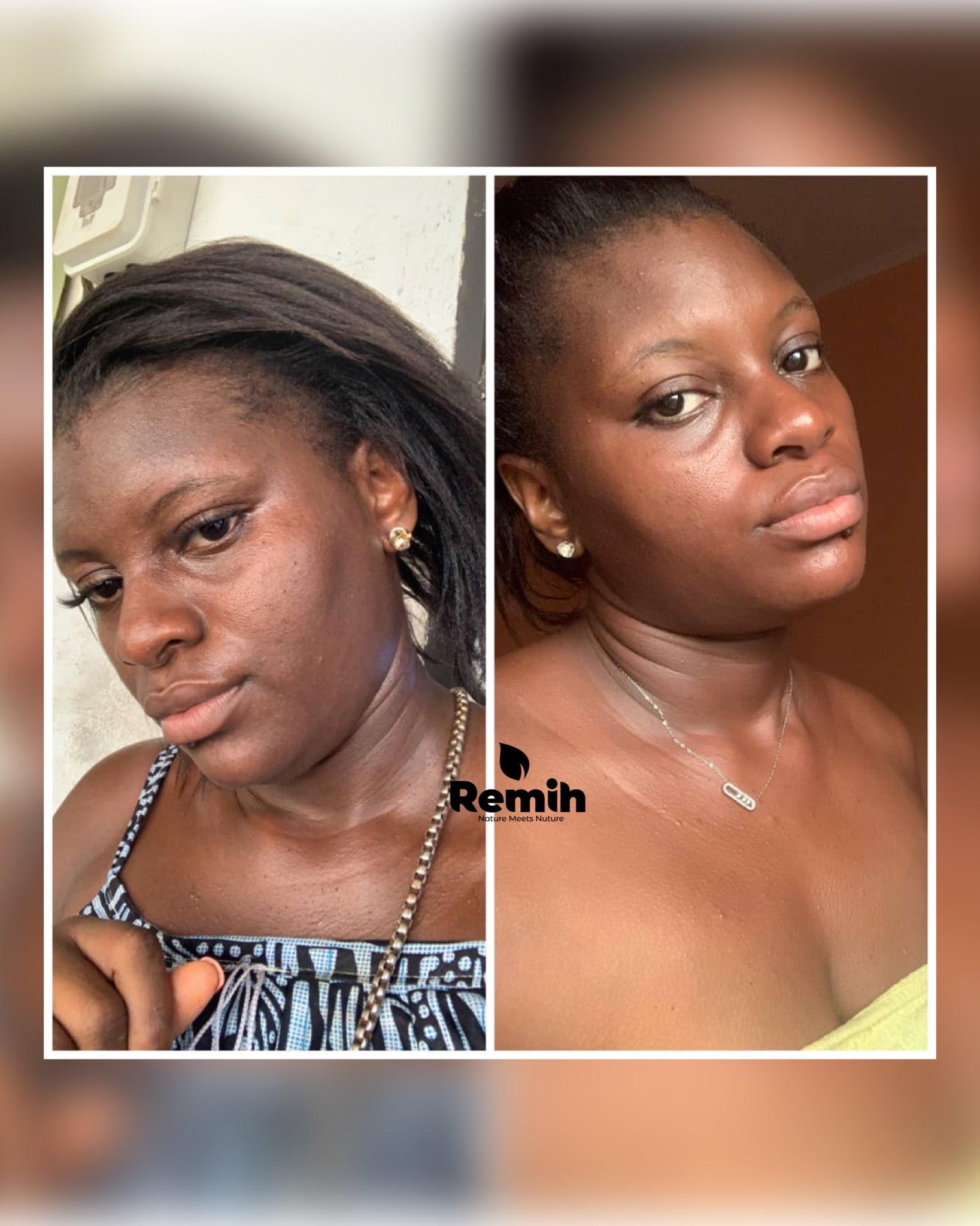 testimonial images showing before and after effect of using myremih product on the face of a customer