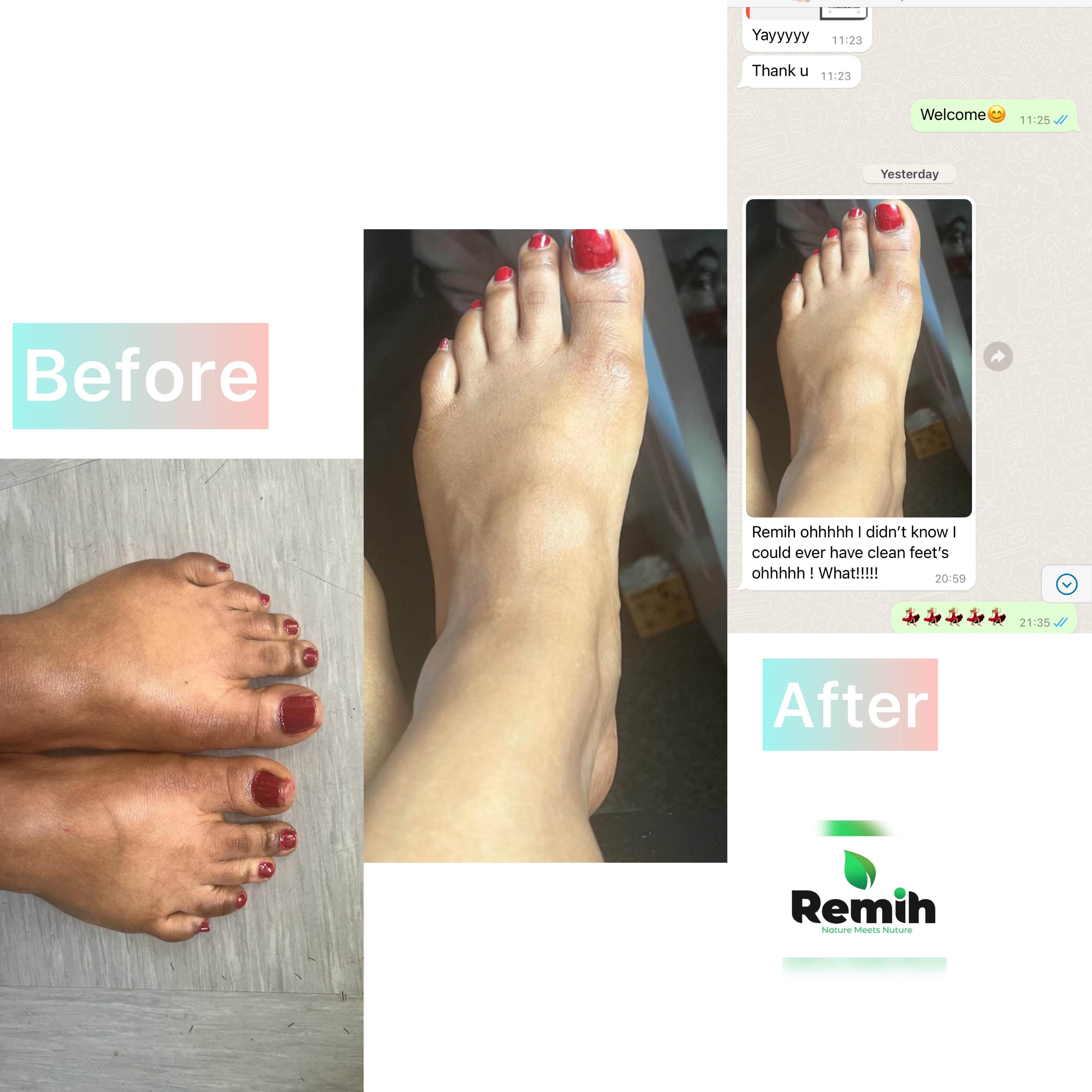 testimonial images showing before and after effect of using myremih product on a customer's leg