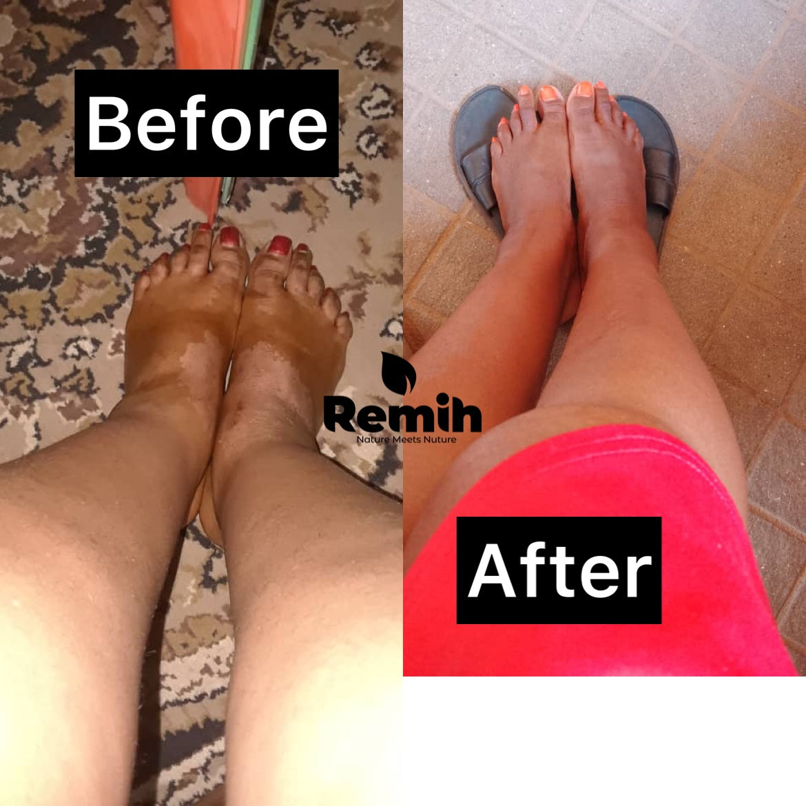 testimonial images showing before and after effect of using myremih product on a customer's leg