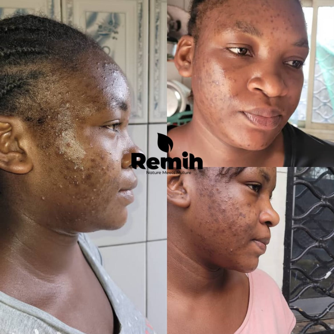 testimonial collage-images showing before and after effect of using myremih product on a customer's face